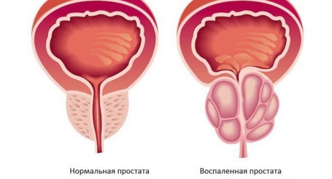 Здрава и възпалена простата